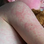 Вспышка кори в Техасе: каждый пятый заболевший попал в больницу