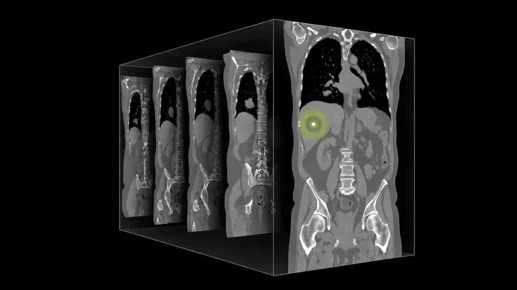 NVIDIA выпустила NV-Reason-CT для 3D КТ анализа
